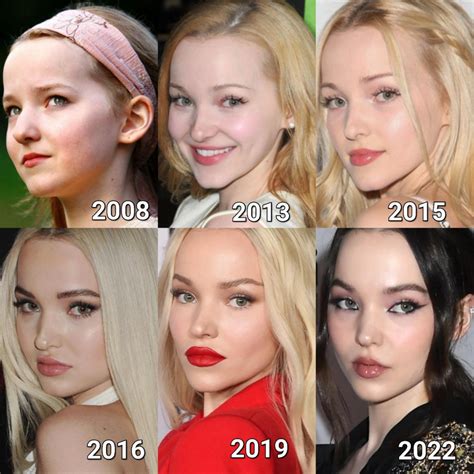 dove cameron surgery|More.